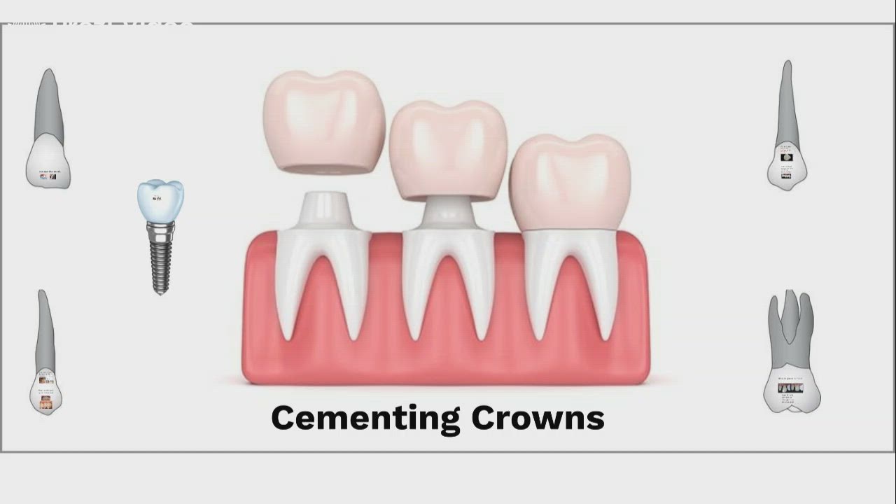 Cementing Crowns by andy weir on Prezi Video